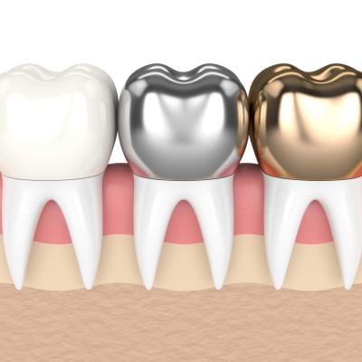 Tooth Crowns