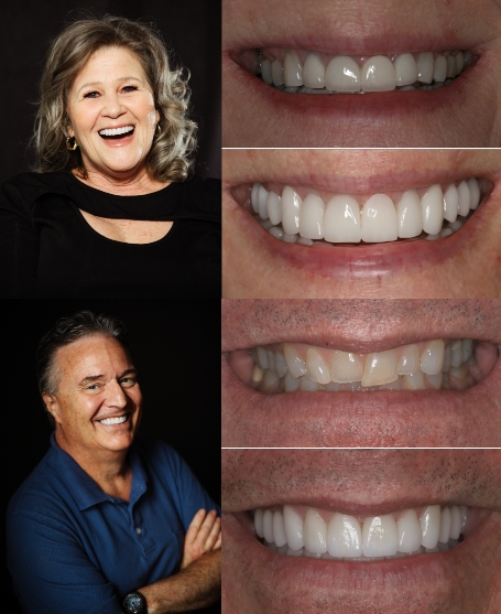 Full mouth restoration before/afters