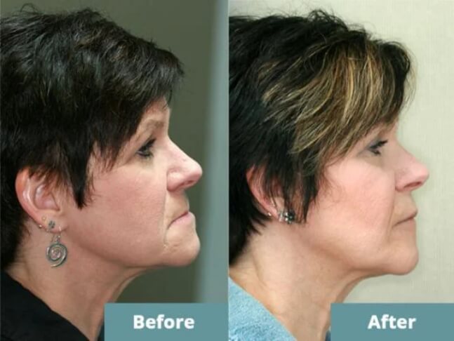 Before after facial growth image