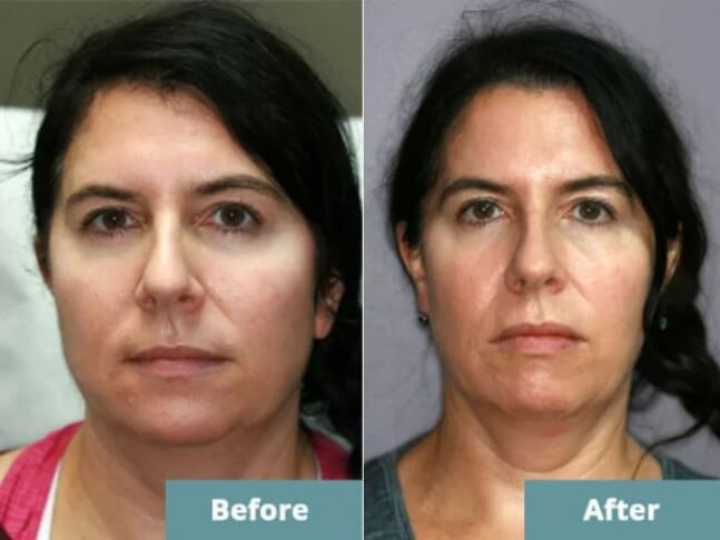 Before after facial growth