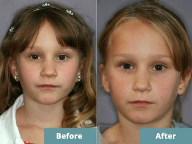Before after orthodontics image 2