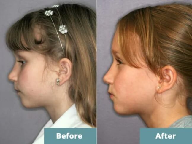 Before after orthodontics image
