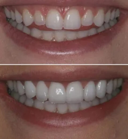 Benefits of mouth restoration image