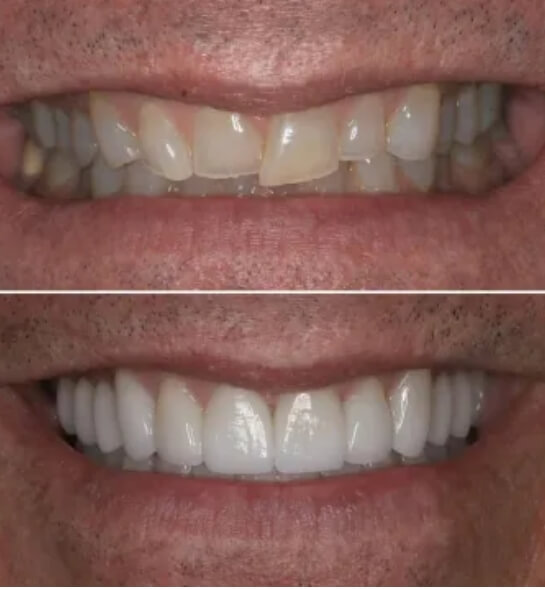 Porcelain veneers benefits image