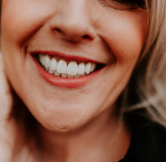 Porcelain venner image