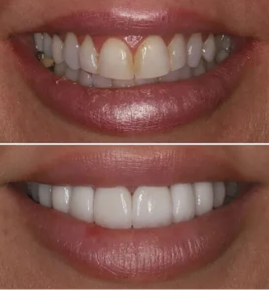 With prep veneer process image