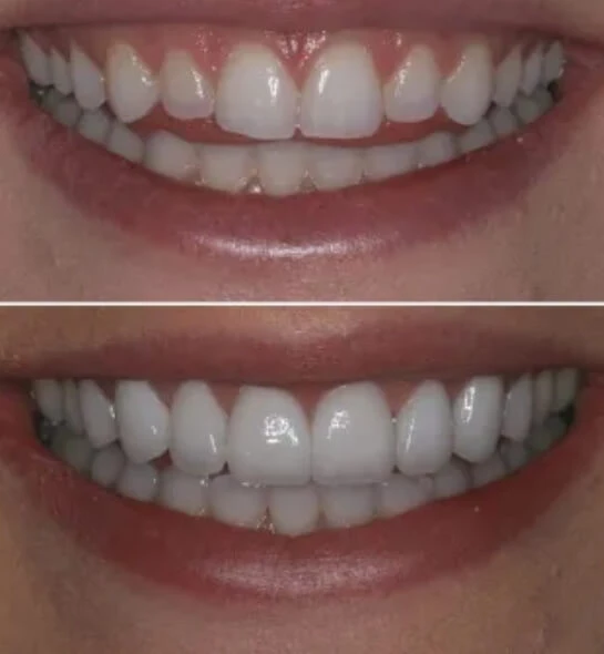Full Mouth Restoration Cost in Pittsburgh