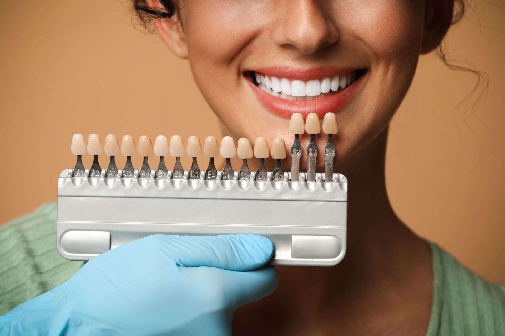 What Are No-Prep Veneers?